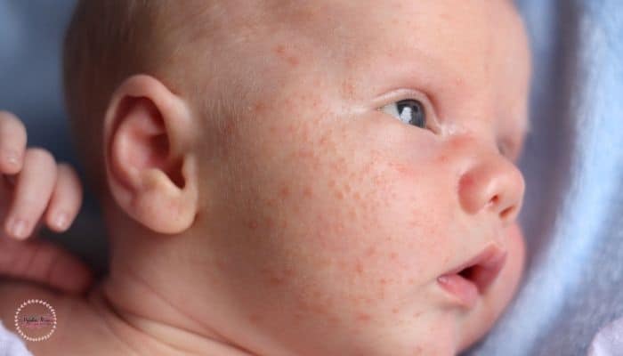 baby acne on the face