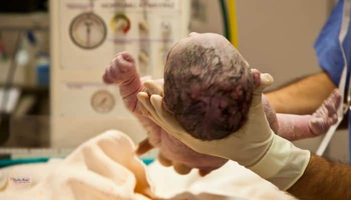 newborns soft head after birth