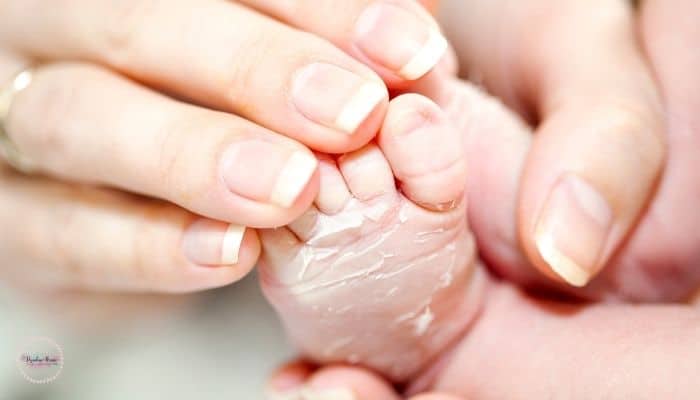 newborn skin is peeling. 